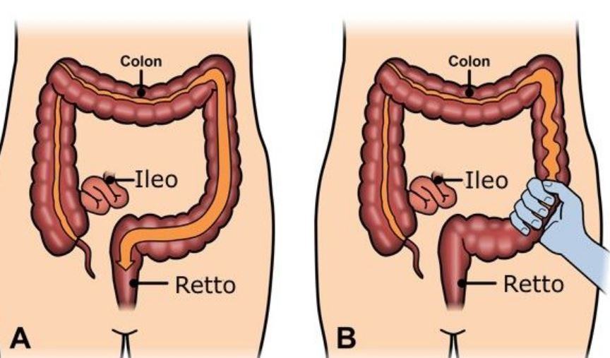 Come capire se l'intestino è infiammato?