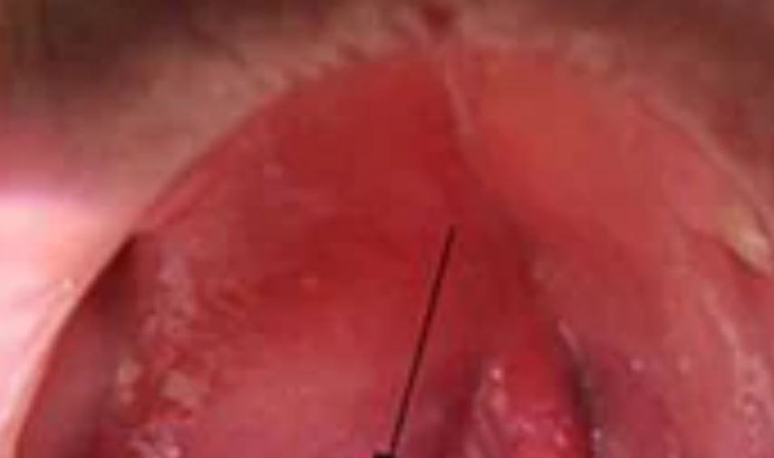 Cos'è un ascesso tonsillare?