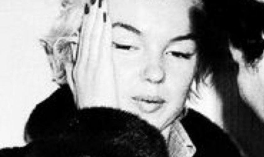 Che malattia aveva Marilyn Monroe?