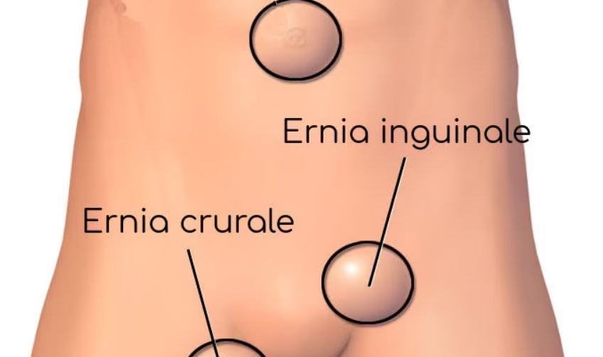 Che significa ernia Crurale?