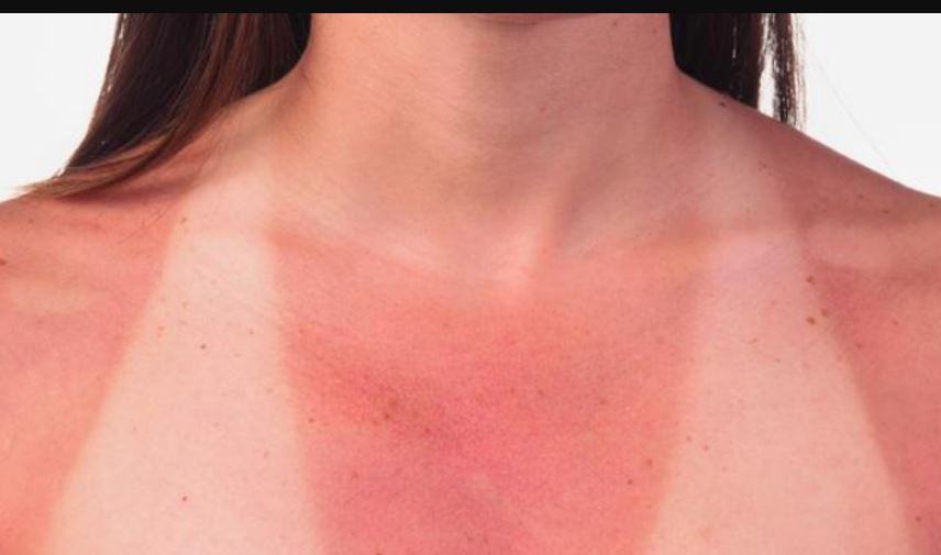 Come curare la pelle bruciata dal sole?