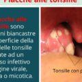 Come disinfettare tonsille