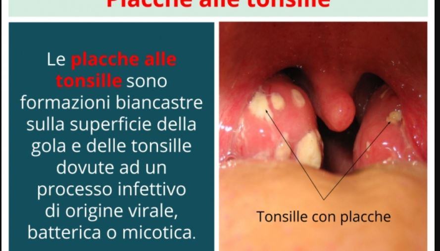 Come disinfettare tonsille?