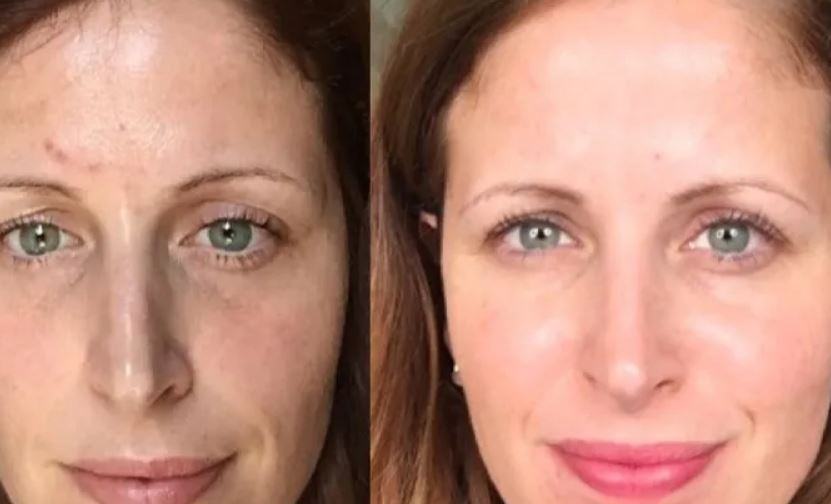 Come ridurre i pori dilatati del viso?
