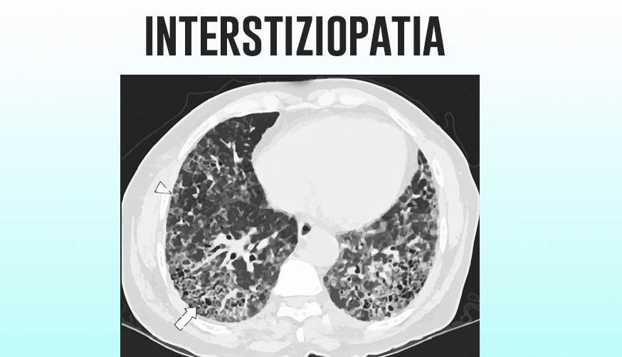 Come si cura l Interstiziopatia polmonare?