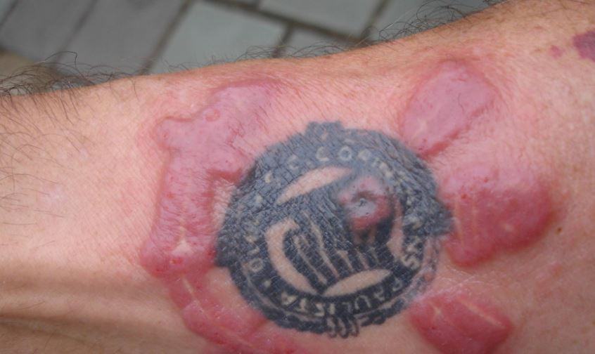 Come si vede l'infezione del tatuaggio?