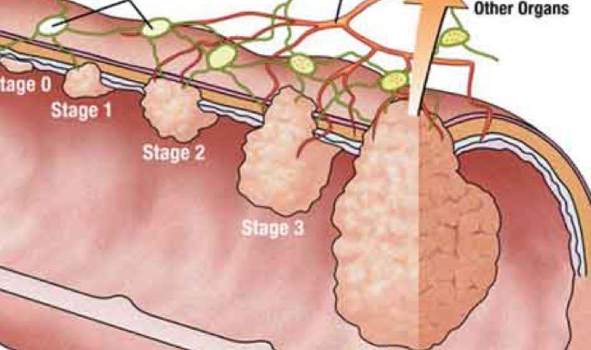 Come sono le feci nel tumore al colon?
