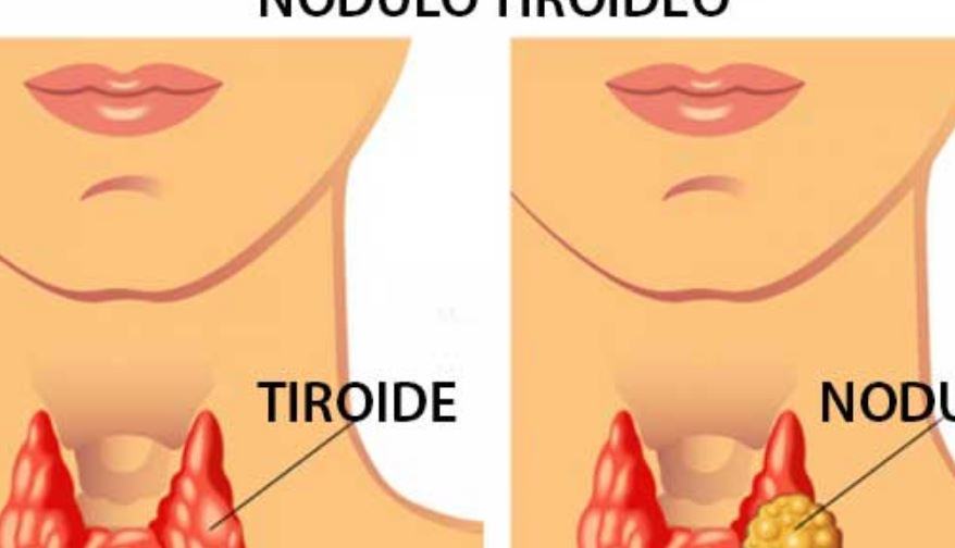 Cosa comporta un nodulo alla tiroide?
