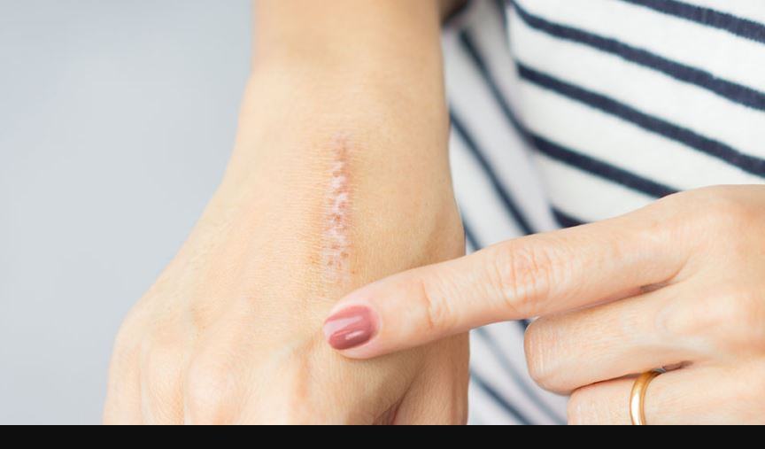 Cosa fare per rimarginare una ferita con punti di sutura?