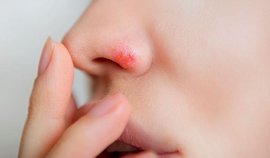 Cosa mettere su herpes naso?