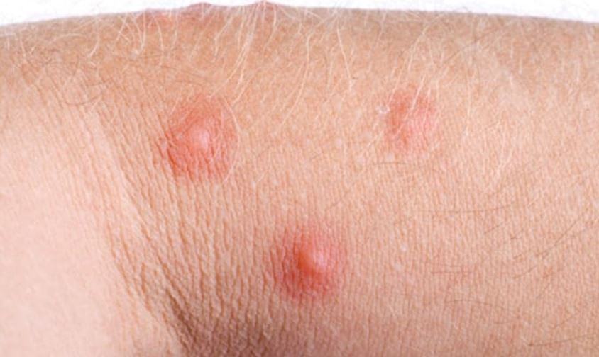 Cosa mettere su una puntura di zanzara infetta?