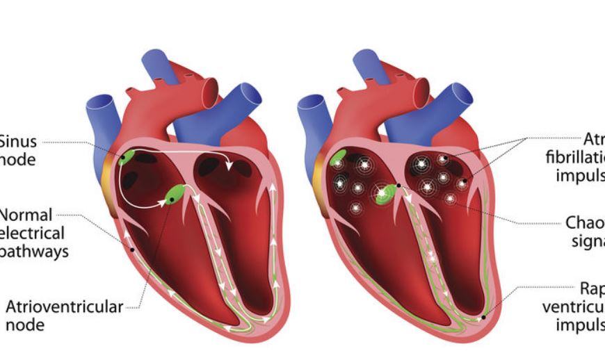 Cosa succede con uno scompenso cardiaco?