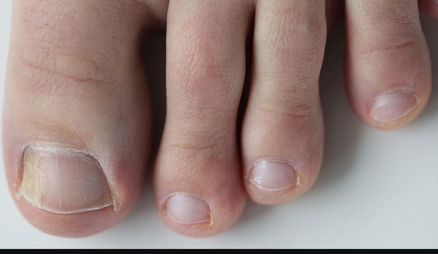 Cosa vuol dire quando le unghie dei piedi sono gialle?