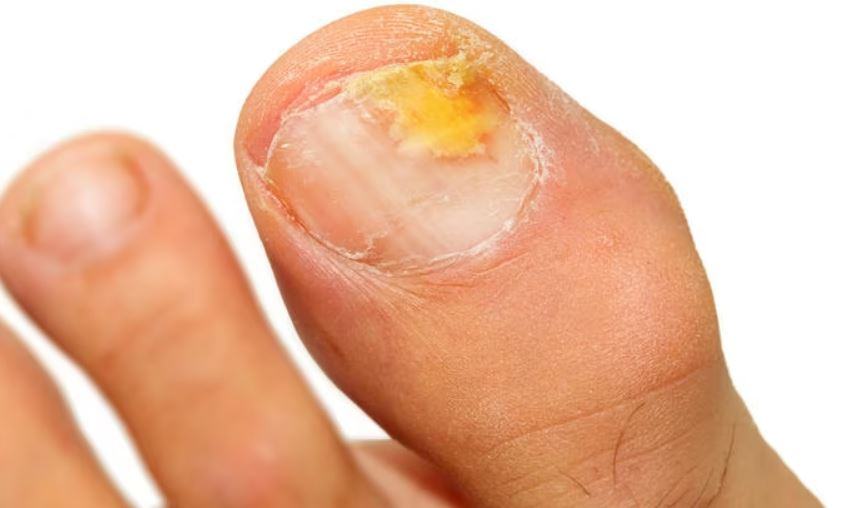 Perché il fungo delle unghie è pericoloso?