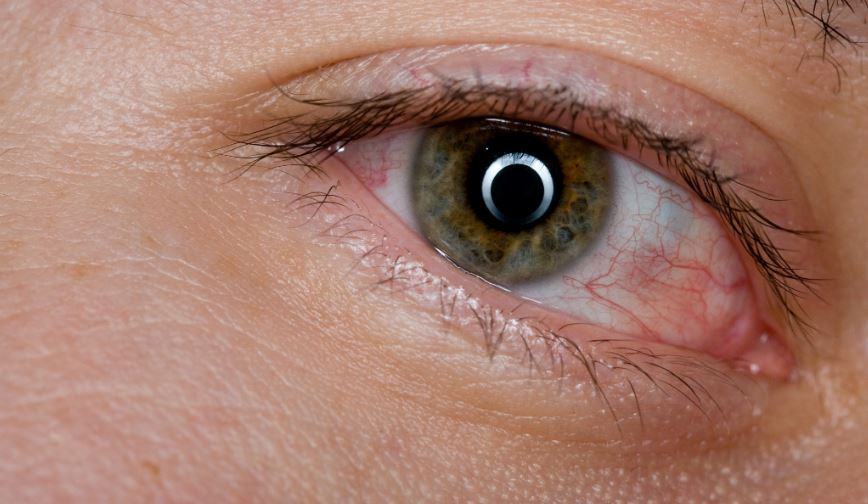Quale allergia provoca prurito agli occhi?