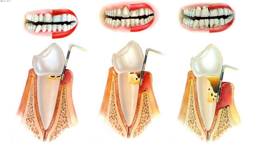 Quali batteri causano la parodontite?