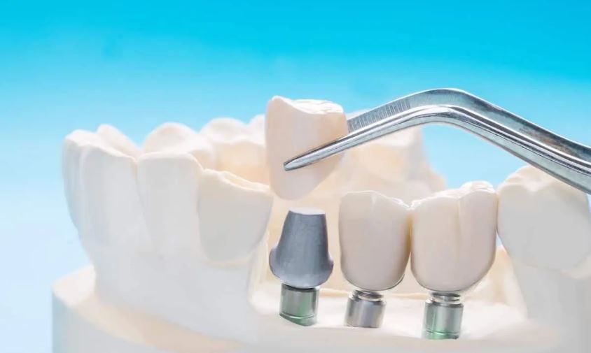 Quanto dura una capsula dentale provvisoria?