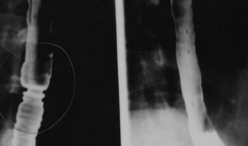 Radiografia con bario in un caso di reflusso gastroesofageo?