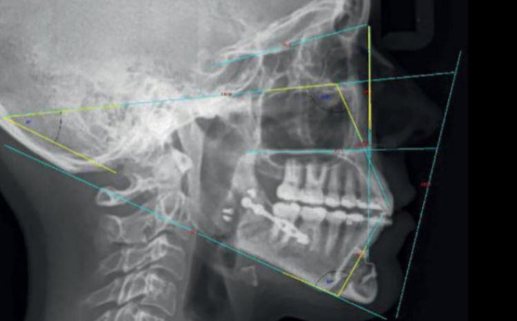Cosa significa teleradiografia del cranio?